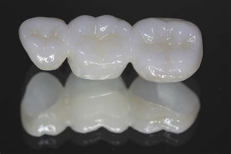 Zirconia Fixed Bridge .